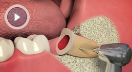 Extractions / Oral Surgery